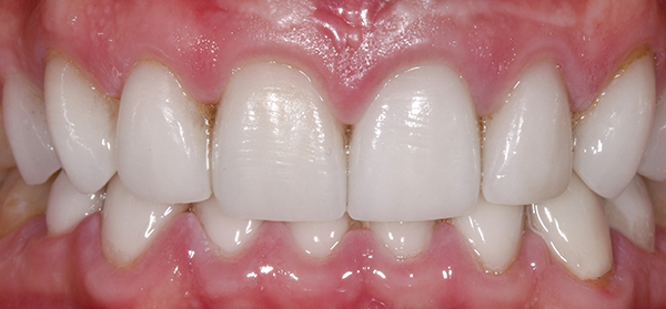 Smile Gallery - After