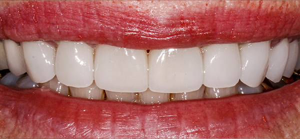 Smile Gallery - After