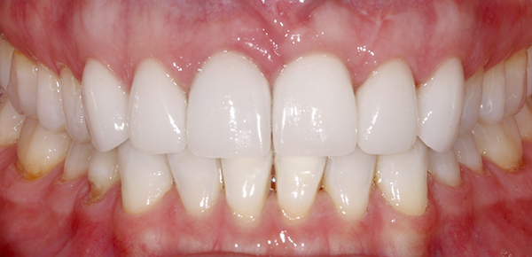 Smile Gallery - After