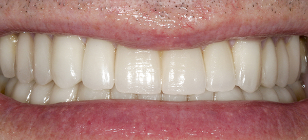 Smile Gallery - After