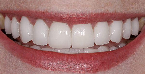 Smile Gallery - After