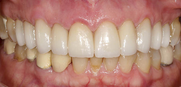 Smile Gallery - After