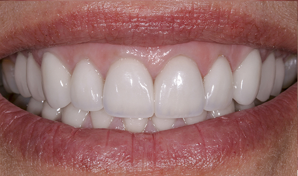 Smile Gallery - After