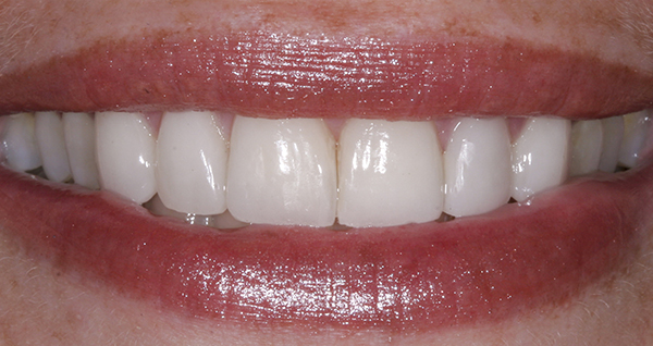 Smile Gallery - After