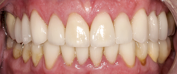 Smile Gallery - After