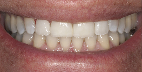 Smile Gallery - After