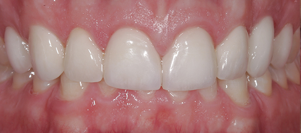 Smile Gallery - After