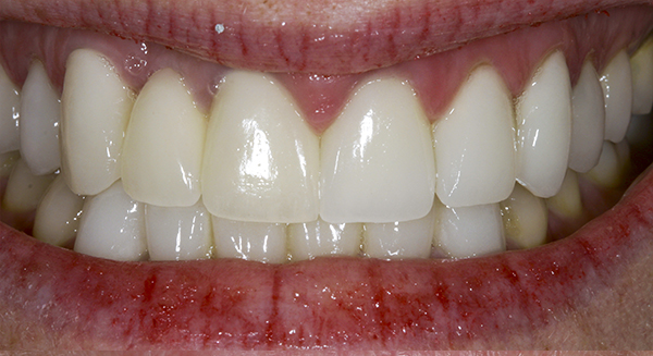 Smile Gallery - After