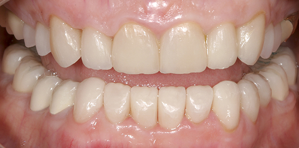 Smile Gallery - After