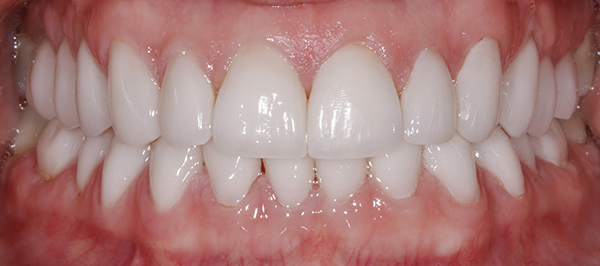 Smile Gallery - After