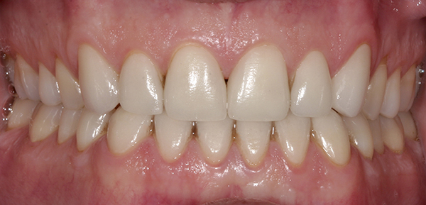 Smile Gallery - After