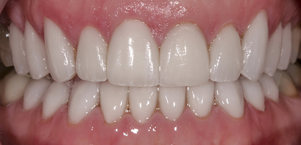 Smile Gallery - After