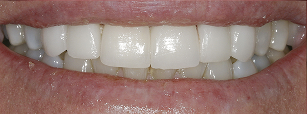 Smile Gallery - After