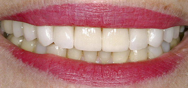 Smile Gallery - After