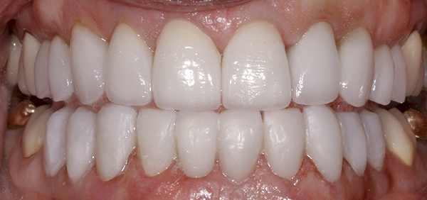 Smile Gallery - After