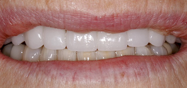 Smile Gallery - After