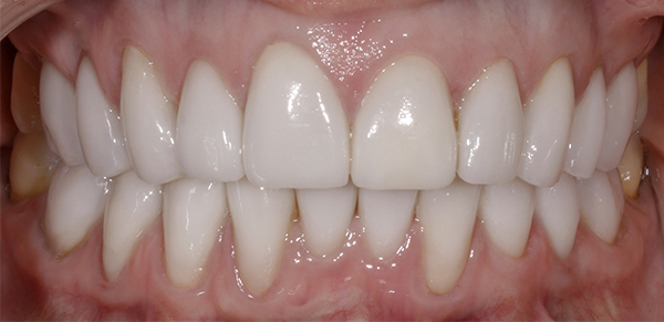 Smile Gallery - After