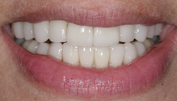 Smile Gallery - After