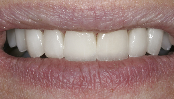 Smile Gallery - After