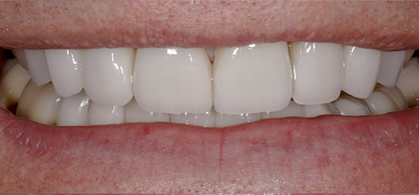 Smile Gallery - After