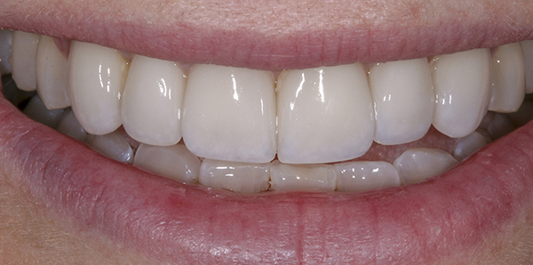 Smile Gallery - After