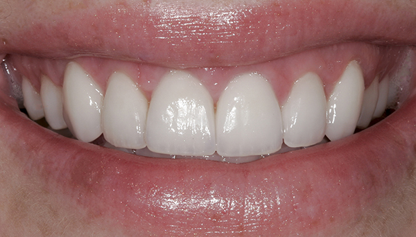 Smile Gallery - After