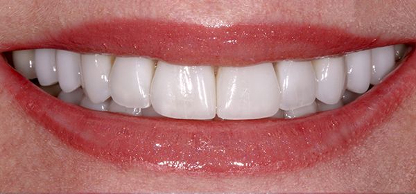 Smile Gallery - After