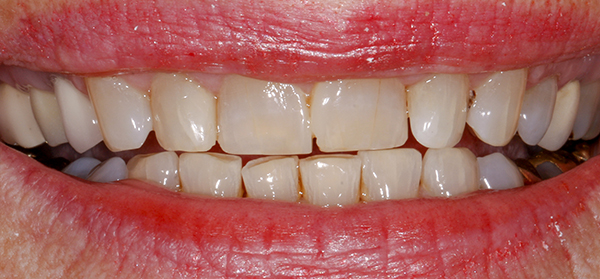 Smile Gallery - Before