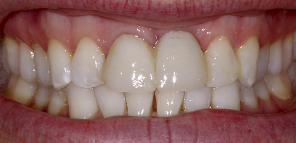 Smile Gallery - Before