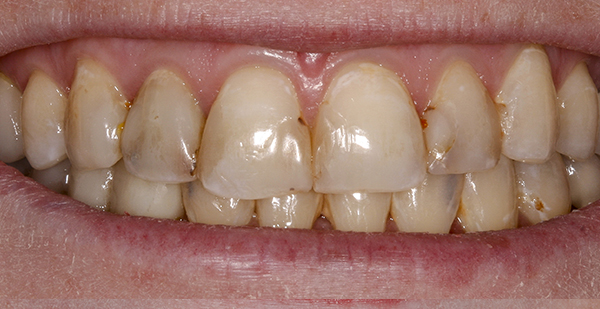 Smile Gallery - Before