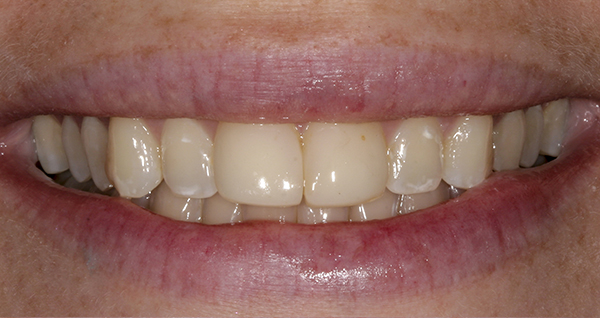 Smile Gallery - Before