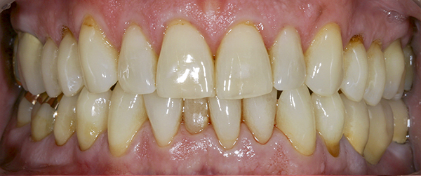 Smile Gallery - Before