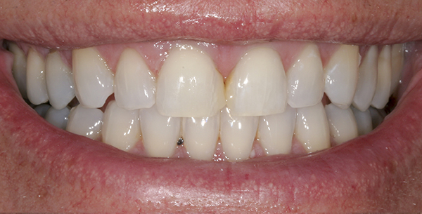 Smile Gallery - Before