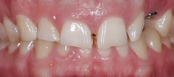 Smile Gallery - Before