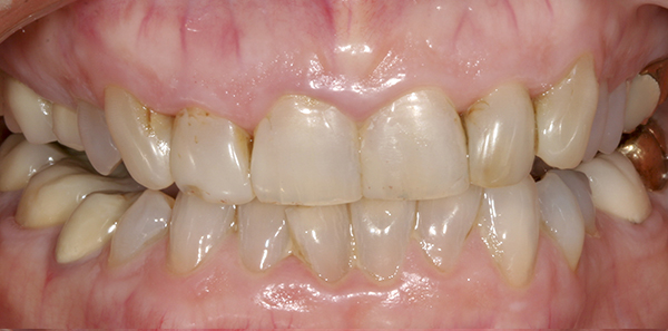 Smile Gallery - Before