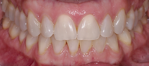 Smile Gallery - Before