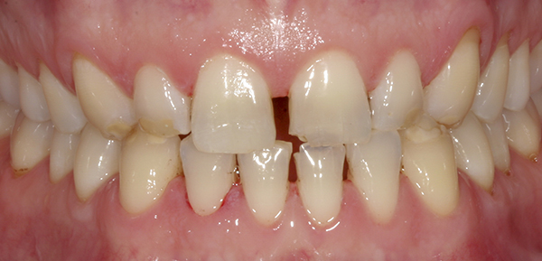 Smile Gallery - Before