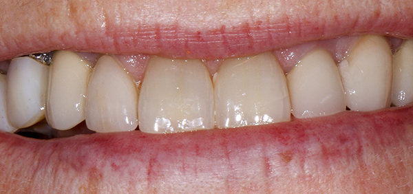 Smile Gallery - Before