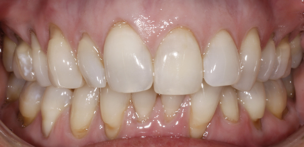 Smile Gallery - Before