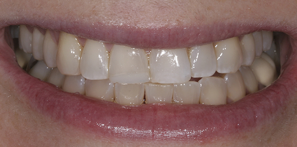 Smile Gallery - Before