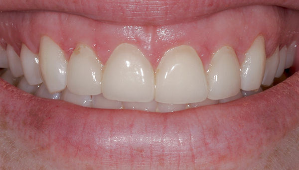 Smile Gallery - Before