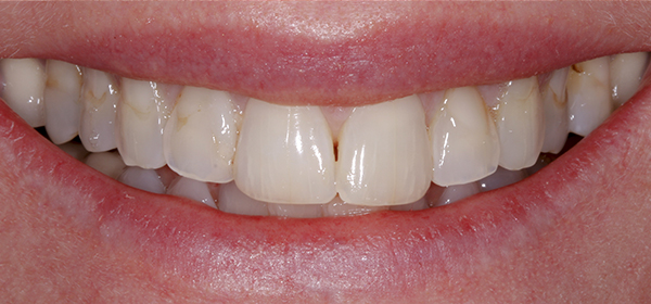 Smile Gallery - Before